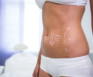 Lipoliza laser